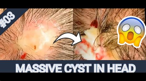 The dermatologist tried to cut the <b>cyst</b> out whole, but ended up squeezing out the white. . Best cyst popping videos 2020